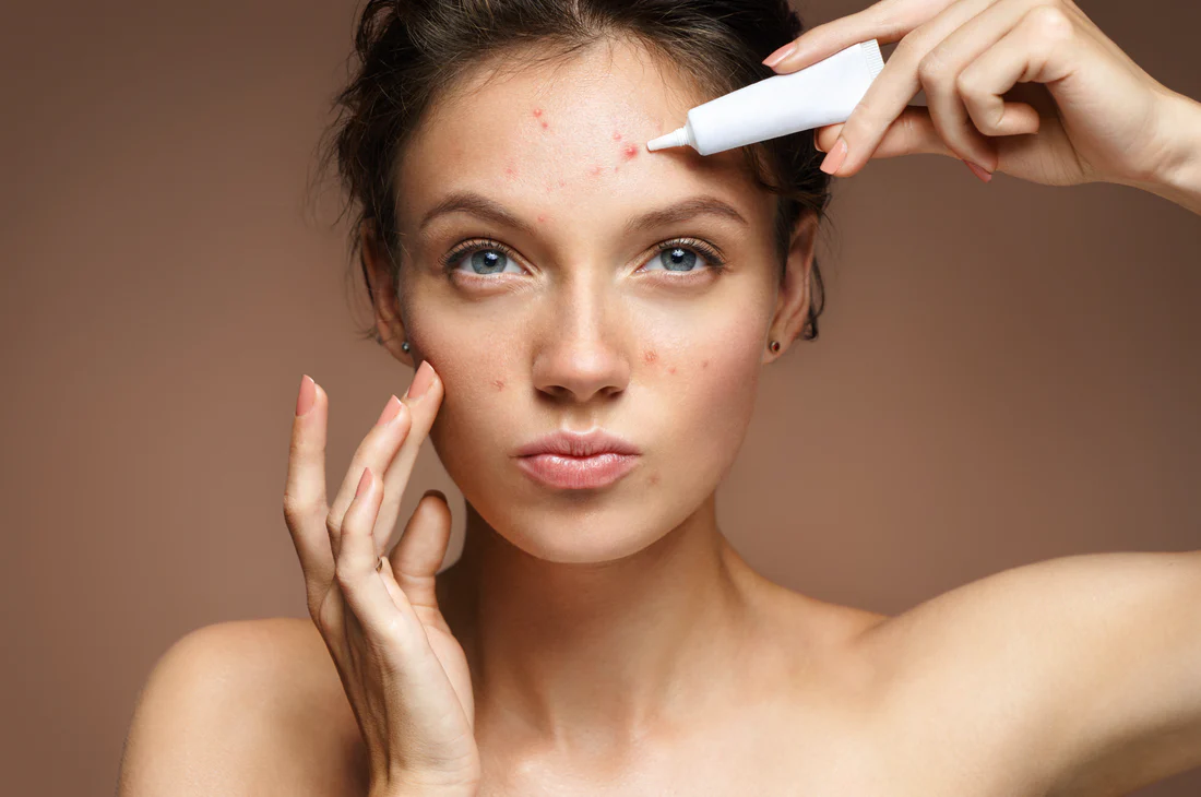 Hábitos que aumentam ou diminuem a acne