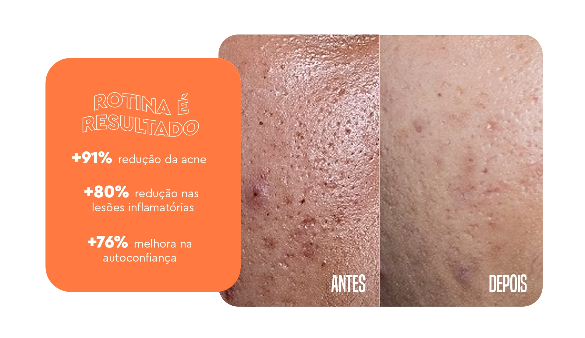 Rotina é resultado – Acnezil